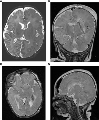 Case Report: Hemispherotomy in the First Days of Life to Treat Drug-Resistant Lesional Epilepsy